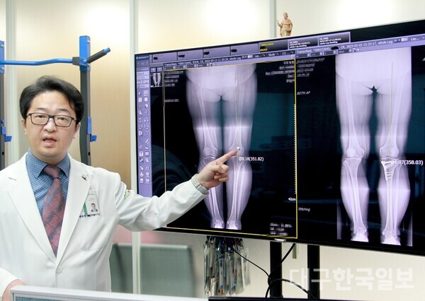 배상근 정형외과 전문의가 퇴행성으로 휜다리 교정술을 받은 40대 여성의 좁아진 관절 부위의 간격을 늘려 다리를 일자축으로 만들어서 하체의 비정상적인 축을 바로 잡은 엑스레이 사진을 보여주고 있다. 대구 백두병원 제공.